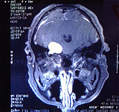 1758923845_082418tumor6.jpg.65c1beada995eb7c55491aff19c115bd.jpg